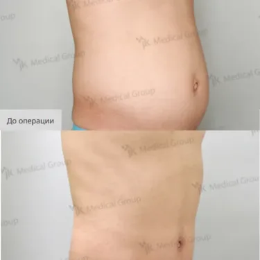 Liposuction