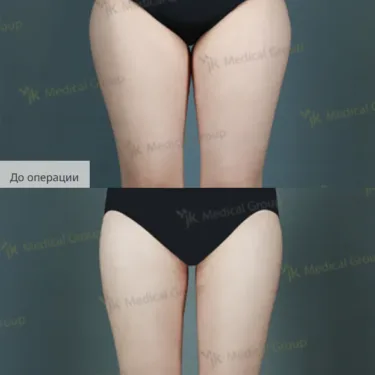 Liposuction