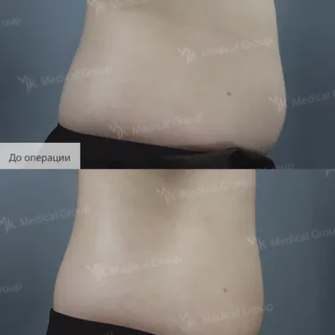 Liposuction