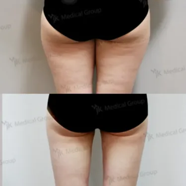 Liposuction