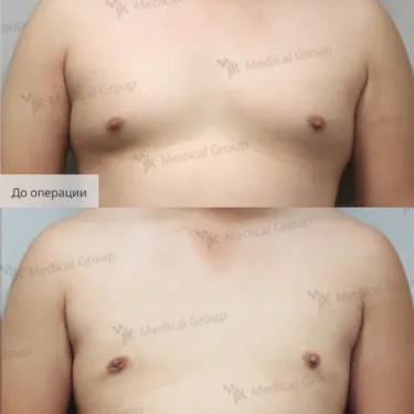 Liposuction