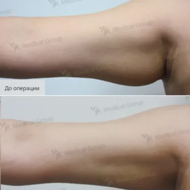 Liposuction
