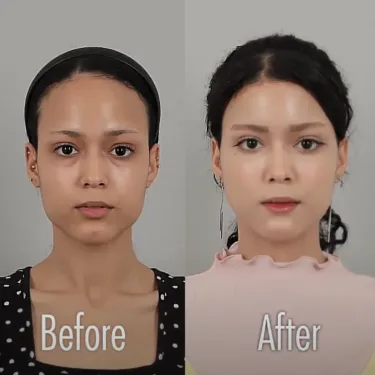 Facial contouring