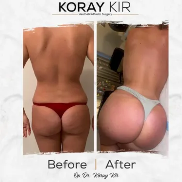  Brazilian Butt Lift (BBL)