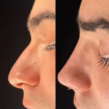 Ринопластика