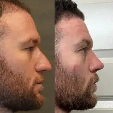 Ринопластика