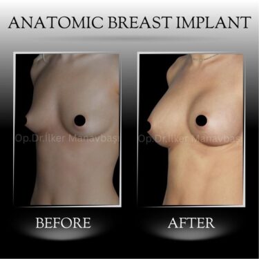 Breast augmentation with anatomical breast implants
