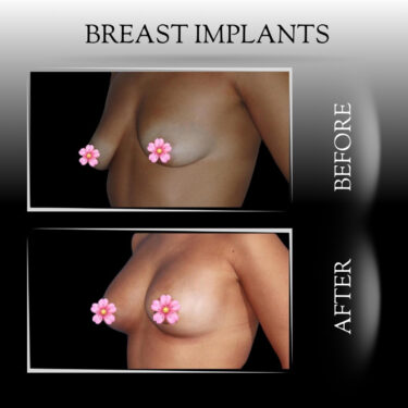 Breast augmentation with anatomical breast implants