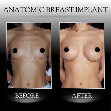 Breast augmentation with anatomical breast implants
