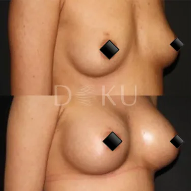 Маммопластика