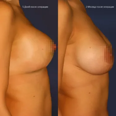 Маммопластика