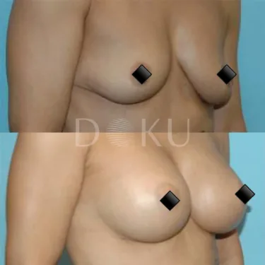 Маммопластика