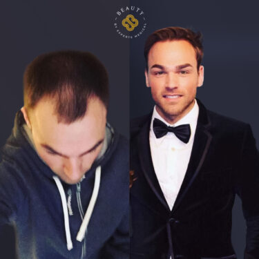 Пересадка волос