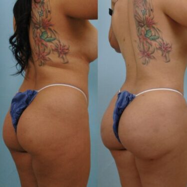  Brazilian Butt Lift (BBL)