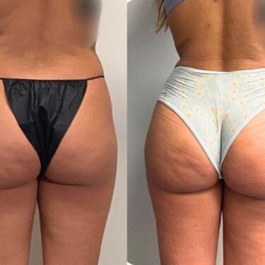  Brazilian Butt Lift (BBL)
