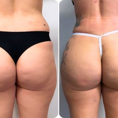  Brazilian Butt Lift (BBL)