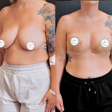 Подтяжка груди