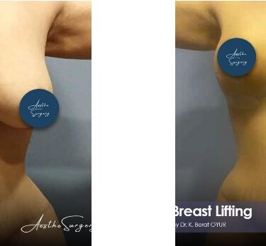 Подтяжка груди