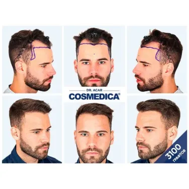 Пересадка волос