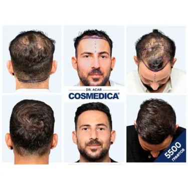 Пересадка волос