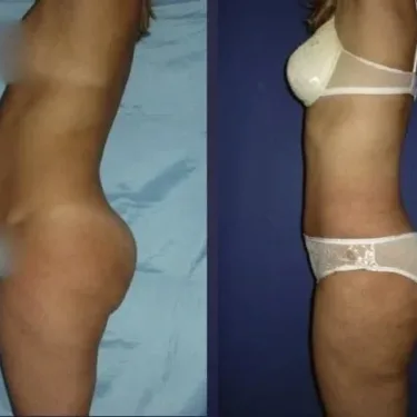 Липосакция 