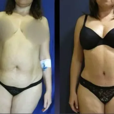 Липосакция