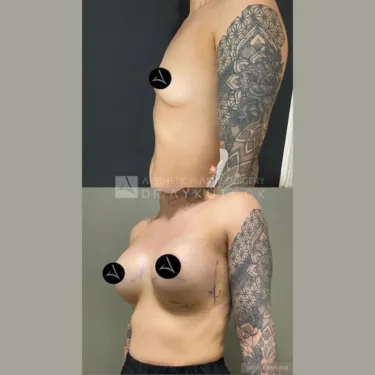 Маммопластика