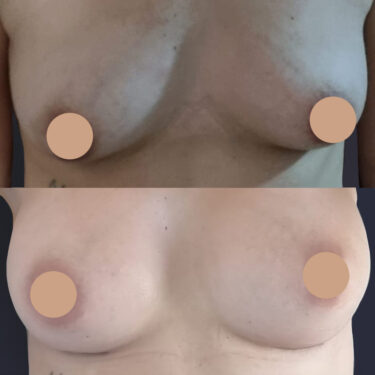 Breast augmentation