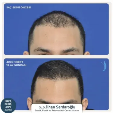 Пересадка волос