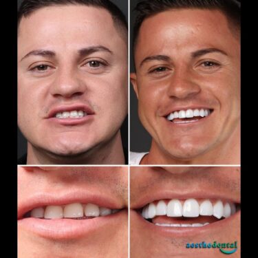 Hollywood Smile