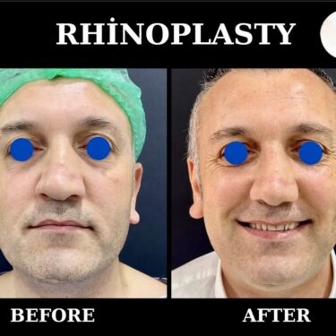 Септопластика