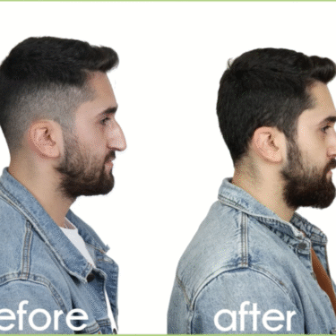 Ринопластика