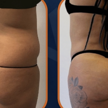  Brazilian Butt Lift (BBL)