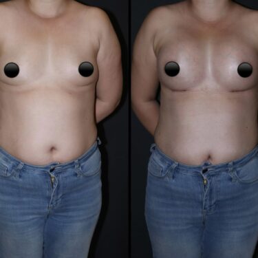 Увеличение груди