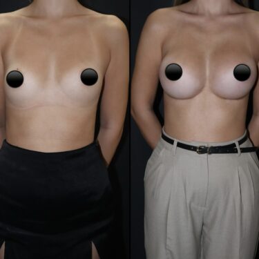 Увеличение груди
