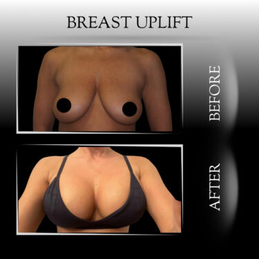 Breast Lift