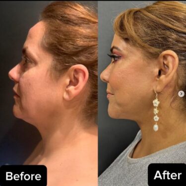 Face and neck lifting