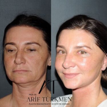 Face and neck lifting