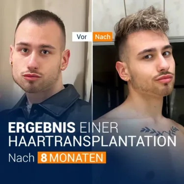 Пересадка волос