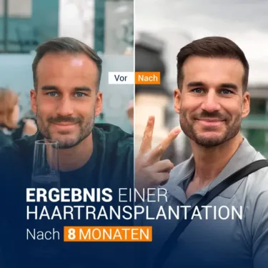 Пересадка волос