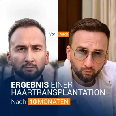 Пересадка волос