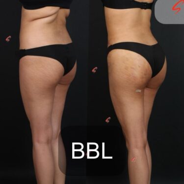  Brazilian Butt Lift (BBL)