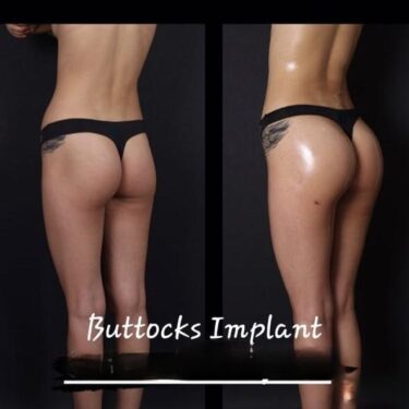  Brazilian Butt Lift (BBL)