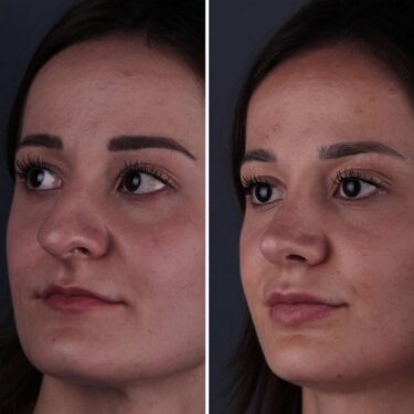 Rhinoplastie 