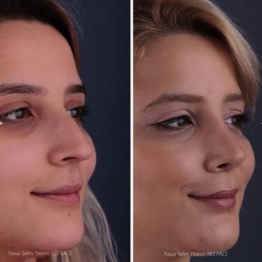 Rhinoplastie 