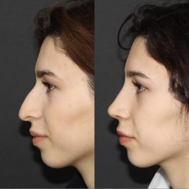 Rhinoplastie 