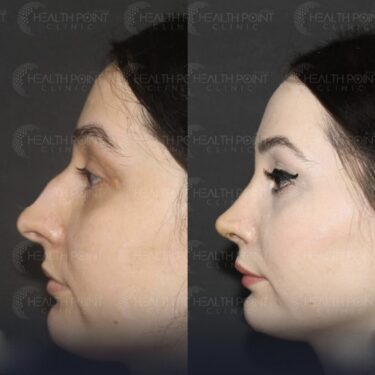 Rhinoplastie 