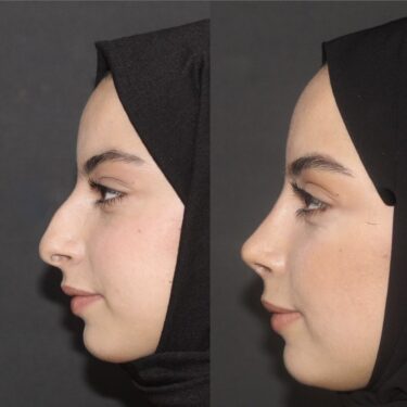 Rhinoplastie 