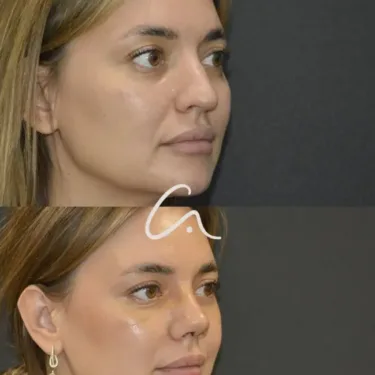 Ринопластика