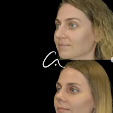 Ринопластика